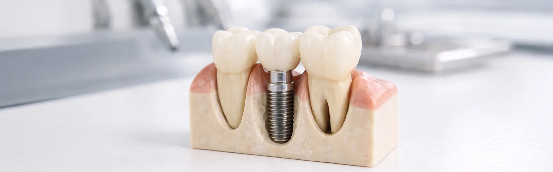 Signs You May Need Bone Grafts Before Getting Dental Implants